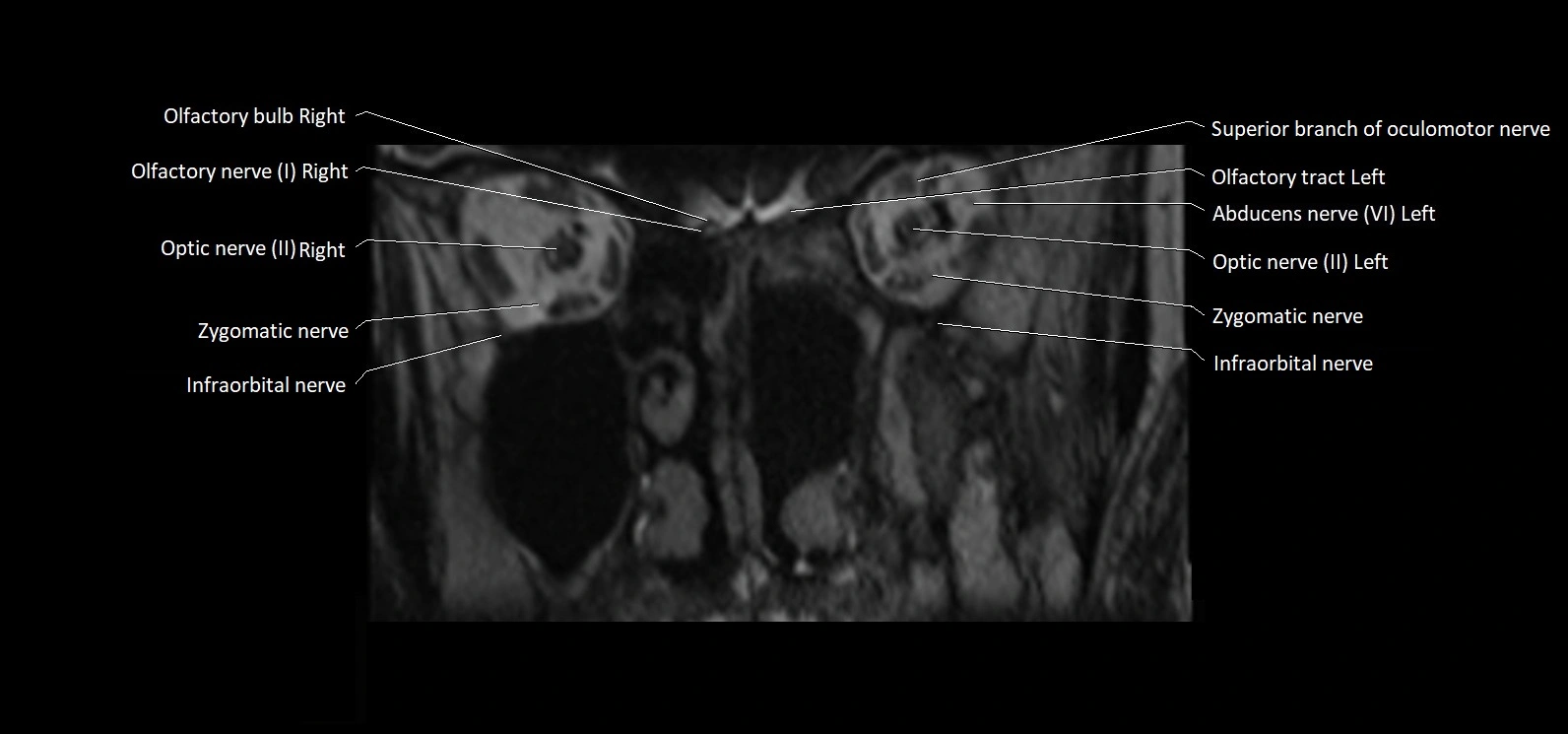 Cranial nerve cross sectional anatomy coronal 3T MRI image 8.webp